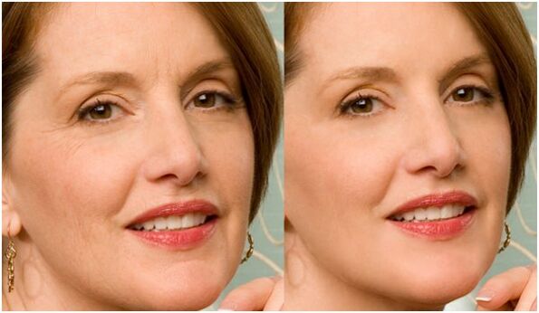 before and after rejuvenation of the facial plasma