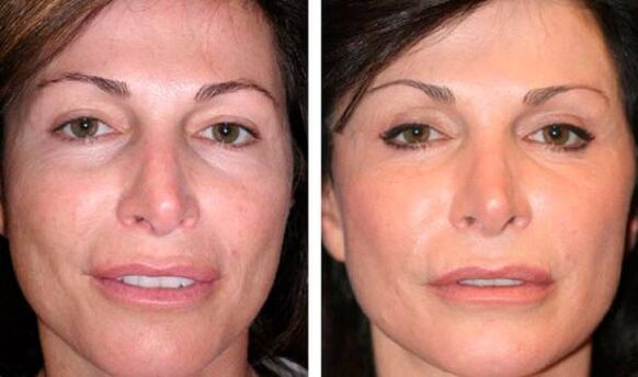 photo before after rejuvenation of the facial skin plasma