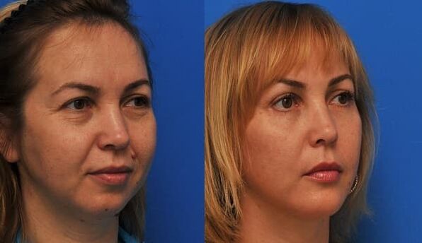 before and after skin rejuvenation with an astringent photo 1