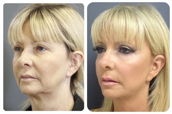 before and after skin rejuvenation with astringent photo 2