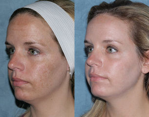 Before and after photos, warranty, and facial rejuvenation