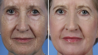 partial facial rejuvenation before and after photos