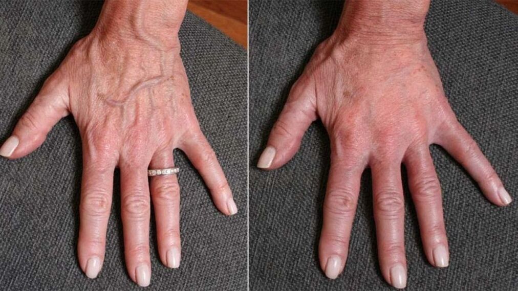 contour plastic, rejuvenating hands photo 1 before and after