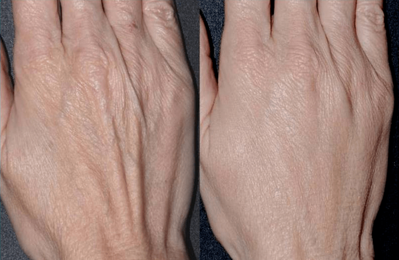 contour plastic, rejuvenating hands photo 2 before and after